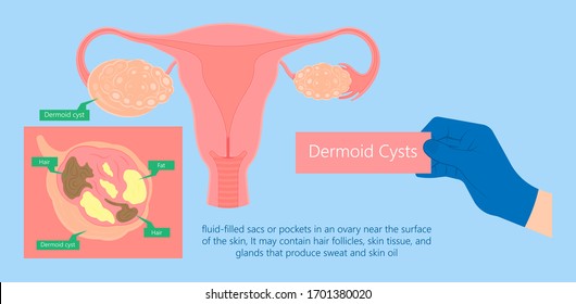 Ovarian Dermoid cysts symptoms of uterus cancer