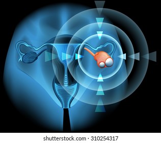 Ovarian diagram with focus illustration