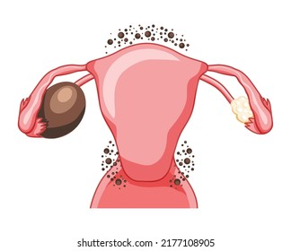 Ovarian endometriomas chocolate cysts Female reproductive system uterus problem. Human medical anatomy internal organs location scheme flat style icon vector illustration isolated on white background