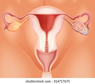 Ovarian tumor in woman illustration