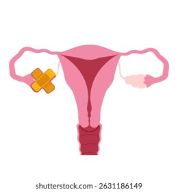 Ovary disease illustration. World ovarian cancer day concept 
