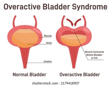 Overactive Bladder Syndrom Normal Bladder Bladder Stock Vector (royalty 