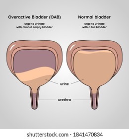 Overactive And Normal Bladder. Urinary System Disease. Urology. Medical Flat Vector Illustration.