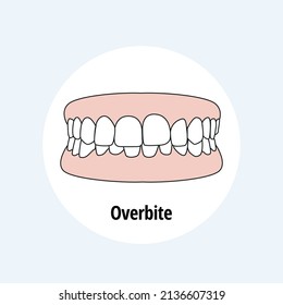 Overbite. Dental problem vector illustration. Dental care concept.