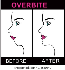 Overbite Jaw Surgery