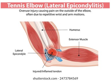 Overuse injury causing elbow pain