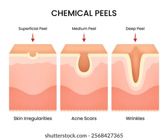 Overview of Chemical Skin Peels