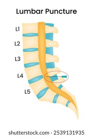 Descripción general de la ilustración de punción lumbar