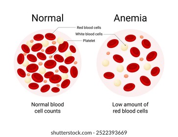 Overview of Normal Blood and Anemia