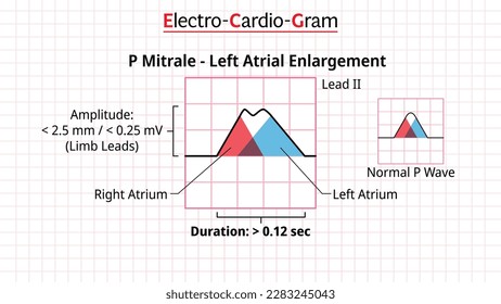 P Wave - P Mitrale - ECG Left Atrial Enlargement or Hypertrophy - Electrocardiogram - Morphology P Wave Vector Illustration svg