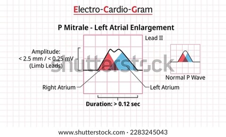P Wave - P Mitrale - ECG Left Atrial Enlargement or Hypertrophy - Electrocardiogram - Morphology P Wave Vector Illustration