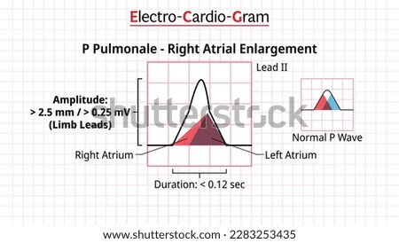 P Wave - P Pulmonale - ECG Right Atrial Enlargement or Hypertrophy - Electrocardiogram - Morphology P Wave Vector Illustration
