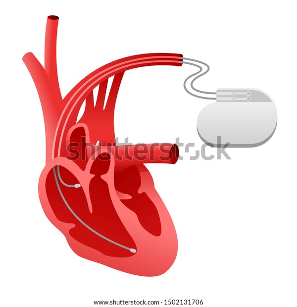 ペースメーカーの心臓刺激器アイコン 心臓インプラント 医療機器スキームと人間の心臓を断面図で表示 分離型ベクター手術イラスト のベクター画像素材 ロイヤリティフリー