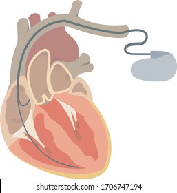 Pacemaker, dual chamber pacemaker diagram