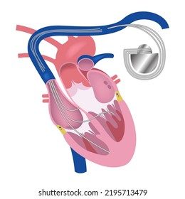 Pacemaker. Heart in longitudinal section. Vector medical illustration