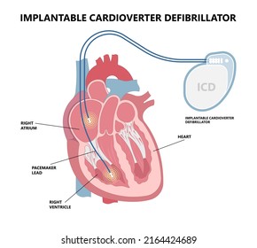 Implantierbarer Cardioverter Defibrillator zur Behandlung von Herzerkrankungen