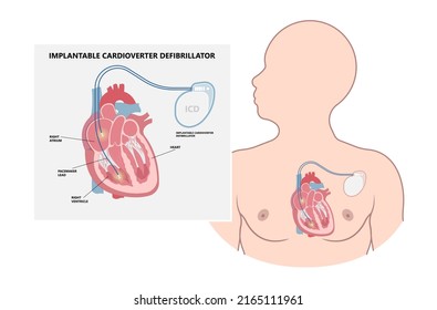 Pacemaker ICD Implantable Cardioverte Defibrillator Pulse Generator Stimulate of Heart Prevent Bradycardia Electronic Medical Device