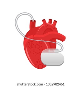 Pacemaker illustration - human heart and cardio implant - vector isolated anatomic medical picture