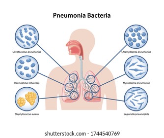 Page template with image of human body and Pneumonia bacteria in magnifying glass. Microbiology. Medical vector illustration in flat style in flat style over white background