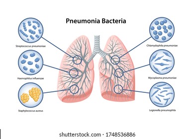 Page template with image of human lungs and Pneumonia bacteria in magnifying glass. Microbiology. Medical vector illustration in flat style in flat style over white background