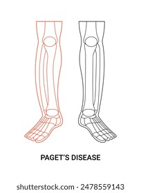 Paget disease medical design with line style illustration