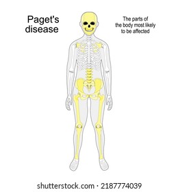 paget's disease of bone. osteitis deformans is a condition of cellular remodeling and deformity of one or more bones. The parts of the humans skeleton most likely to be affected. Vector illustration