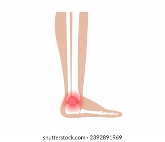 Pain in ankle joint Arthritis ankle joint pain syndrome ankle Skeleton Bones Pain Injury and Inflammation vector illustration.