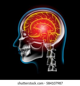 Pain in the Brain, x ray