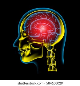 Pain in the Brain, x ray