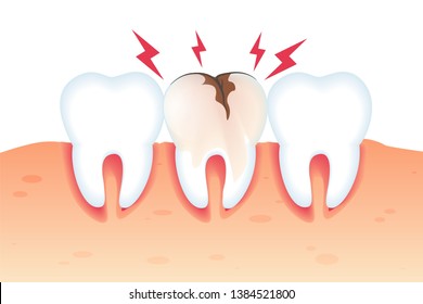 Pain in Broken Tooth Illustration Realistic 3d. Special Assistance in Maintaining Oral Hygiene. Closeup Healthy White Teeth and Tooth Need Repair. Vector Flat. Dental Diseases and Pain.