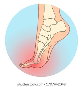 Pain in foot joint medical infographic. Vector illustration.