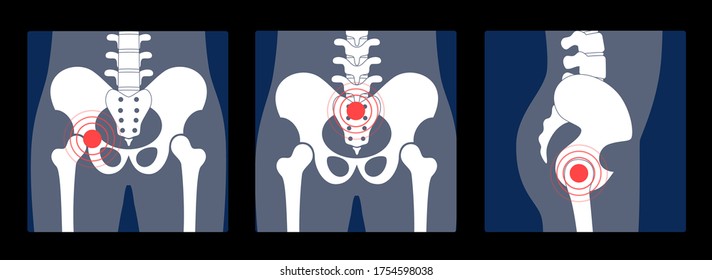 Dolor, fractura o inflamación en la pelvis. Anatomía humana en rayos X. Hueso de cadera principal sacro, ilio, cocix y fémur sobre reontgen. Vista frontal y lateral. Ilustración vectorial plana.