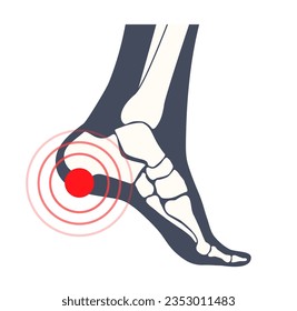 Pain of the heel anatomical poster. Ankle and foot diseases. Calcaneal spur, achilles tendinitis, plantar fascia strain or fasciitis treatment. Ankle bones and ligament medical vector illustration