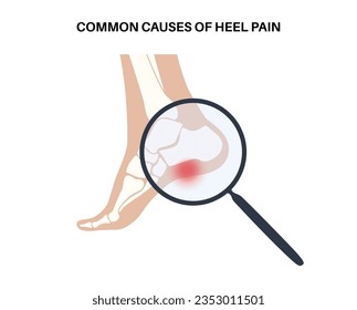 Pain of the heel anatomical poster. Ankle and foot diseases. Calcaneal spur, achilles tendinitis, plantar fascia strain or fasciitis treatment. Ankle bones and ligament medical vector illustration