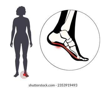 Pain of the heel anatomical poster. Ankle and foot diseases. Calcaneal spur, achilles tendinitis, plantar fascia strain or fasciitis treatment. Ankle bones and ligament medical vector illustration