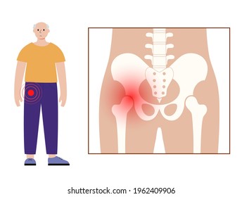 Pain in hip or pelvis. Skeleton x ray silhouette medical poster. Joints and cartilage in human body concept. Rheumatoid arthritis, inflammation, bone disease concept. Isolated flat vector illustration