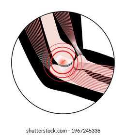 Pain in human arm. Medial epicondylitis golfer elbow. Trauma or inflammation in hand. Muscular system and skeletal anatomical poster. Structure of muscle groups and bones isolated vector illustration.
