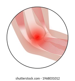 Dolor en el brazo humano. Codo dorfer medial de epicondilitis dorada. Trauma o inflamación en la mano. Sistema muscular y afiche anatómico esquelético. Estructura de los grupos musculares y de los huesos ilustración vectorial aislada.