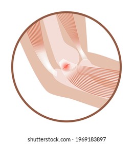 Pain in human arm. Medial epicondylitis golfer elbow. Trauma or inflammation in hand. Muscular system and skeletal anatomical poster. Structure of muscle groups and bones isolated vector illustration.