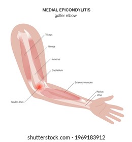 Pain in human arm. Medial epicondylitis golfer elbow. Trauma or inflammation in hand. Muscular system and skeletal anatomical poster. Structure of muscle groups and bones isolated vector illustration.