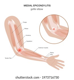 Pain in human arm. Medial epicondylitis golfer elbow. Trauma or inflammation in hand. Muscular system and skeletal anatomical poster. Structure of muscle groups and bones isolated vector illustration.