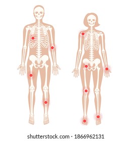 Dolor en el cuerpo humano. Silueta de esqueleto masculino y femenino. Inflamación, artritis o fractura de las extremidades. Estructura ósea, cartílago y articulaciones. Afiche médico. Ilustración vectorial de rayos planos.