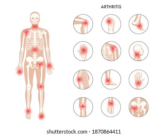 Pain in human body. Male skeleton silhouette. Spine, knee and other joint icons. Arthritis, inflammation, fracture, bone structure and cartilage concept. Medical poster. Flat xray vector illustration