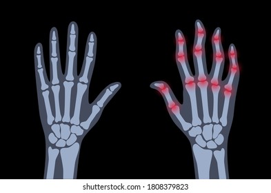 Pain and inflammation in hand. Normal and sore arms. Rheumatoid arthritis symptom on human joints and bones. Skeleton x ray scan. Finger disease flat vector illustration. Banner, poster for clinic.