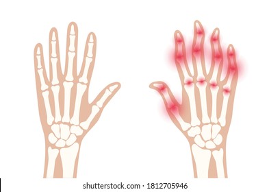 Pain and inflammation in hand. Normal and sore arms. Rheumatoid arthritis symptom on human joints and bones. Skeleton x ray scan. Finger disease flat vector illustration. Banner, poster for clinic.