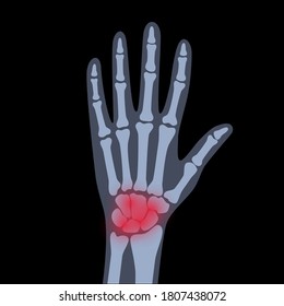 Pain and inflammation in hand on x ray. Rheumatoid arthritis symptom on human joints and bones. Skeleton scan concept. Finger disease flat vector illustration. Banner, poster for clinic and hospital