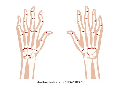 Pain and inflammation in hand on x ray. Rheumatoid arthritis symptom on human joints and bones. Skeleton scan concept. Finger disease flat vector illustration. Banner, poster for clinic and hospital