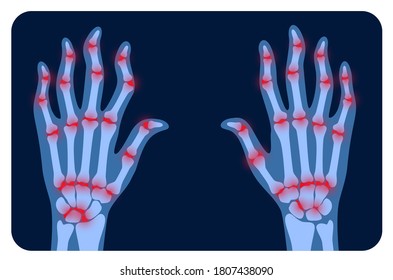 Pain and inflammation in hand on x ray. Rheumatoid arthritis symptom on human joints and bones. Skeleton scan concept. Finger disease flat vector illustration. Banner, poster for clinic and hospital