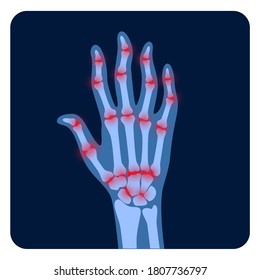 Pain and inflammation in hand on x ray. Rheumatoid arthritis symptom on human joints and bones. Skeleton scan concept. Finger disease flat vector illustration. Banner, poster for clinic and hospital