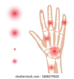 Pain and inflammation in hand on x ray. Rheumatoid arthritis symptom on human joints and bones. Skeleton scan concept. Finger disease flat vector illustration. Banner, poster for clinic and hospital